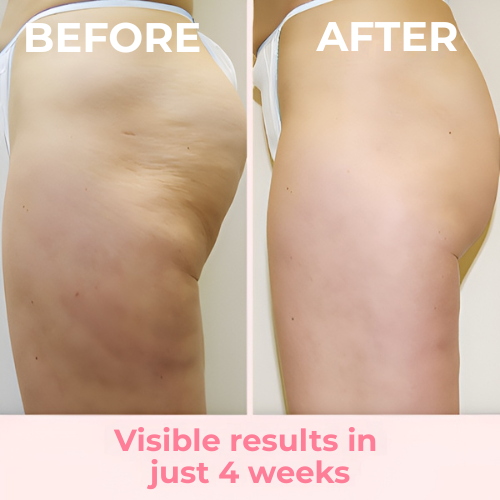 SilkRoller – Smooth, Firm Skin in Minutes!